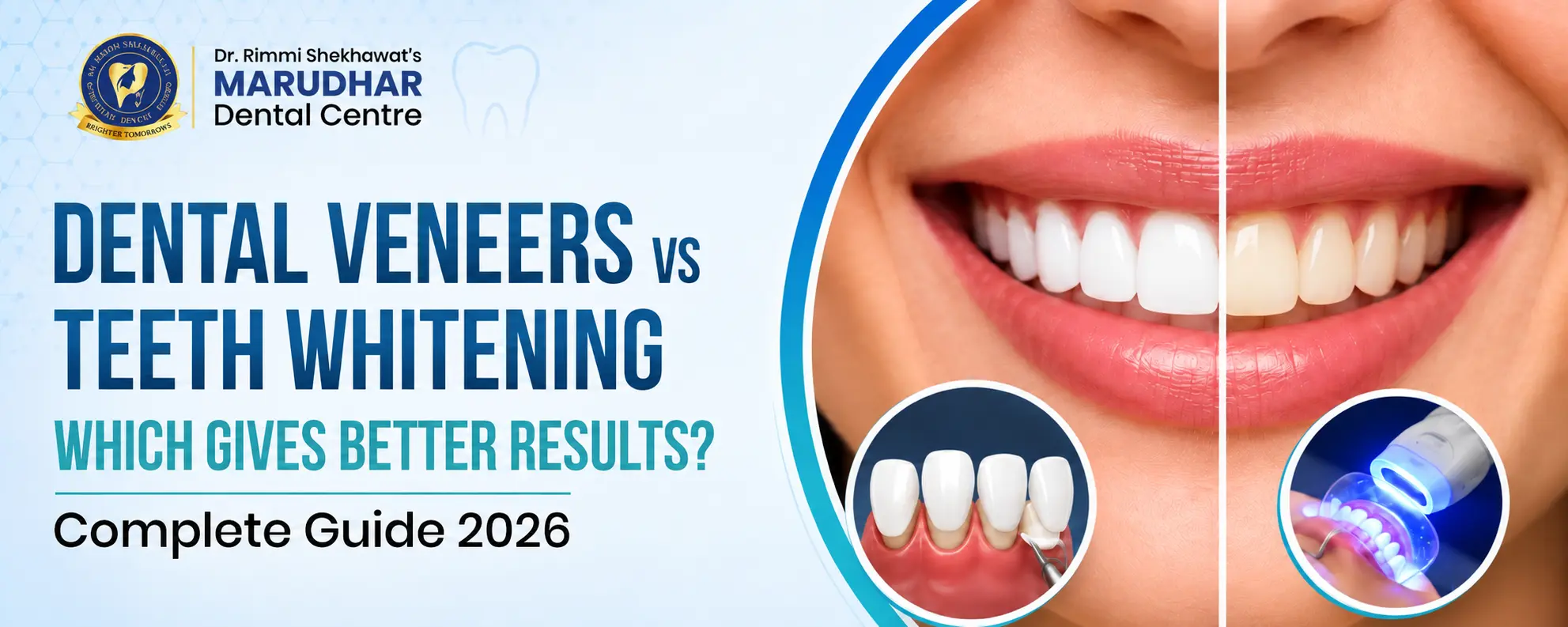 Dental Veneers vs Teeth Whitening